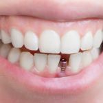 Exploring Permanent Solutions for Seniors in Need of Dental Implants