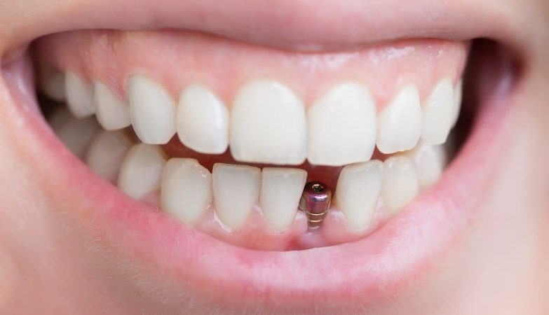 Exploring Permanent Solutions for Seniors in Need of Dental Implants