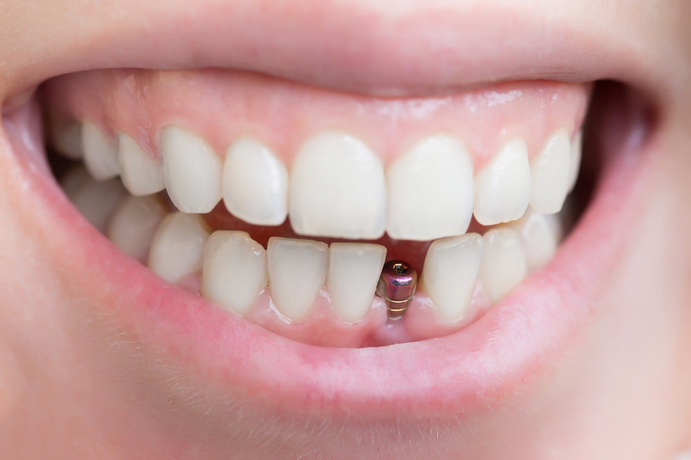 Exploring Permanent Solutions for Seniors in Need of Dental Implants
